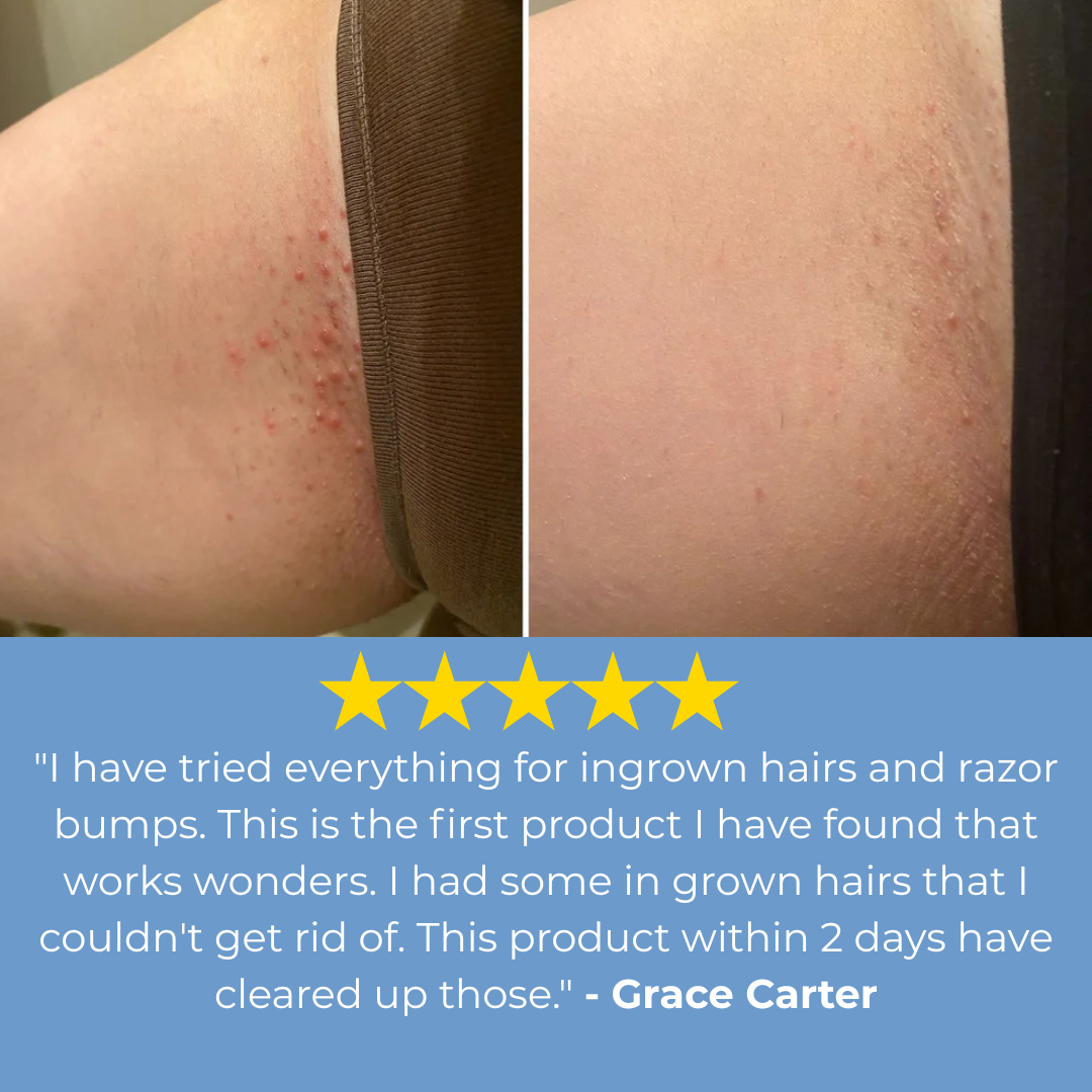 Smoothing Solution Ingrown Hair Treatment